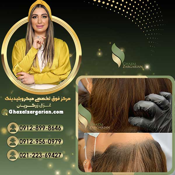 هاشور اسکالپ سر با تجهیزات باکیفیت