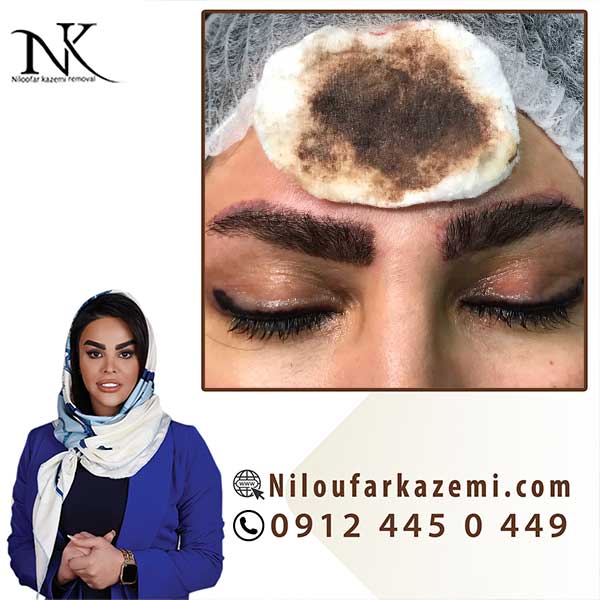 آموزش ریموو تاتو با بروزترین تکنیک با روش استفاده از مواد ریموور