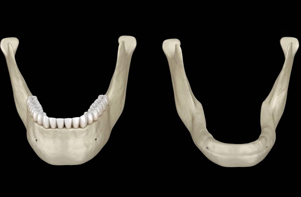 تحلیل رفتن استخوان فک 