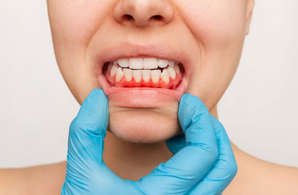 عوارض های جانبی سفید کردن دندان