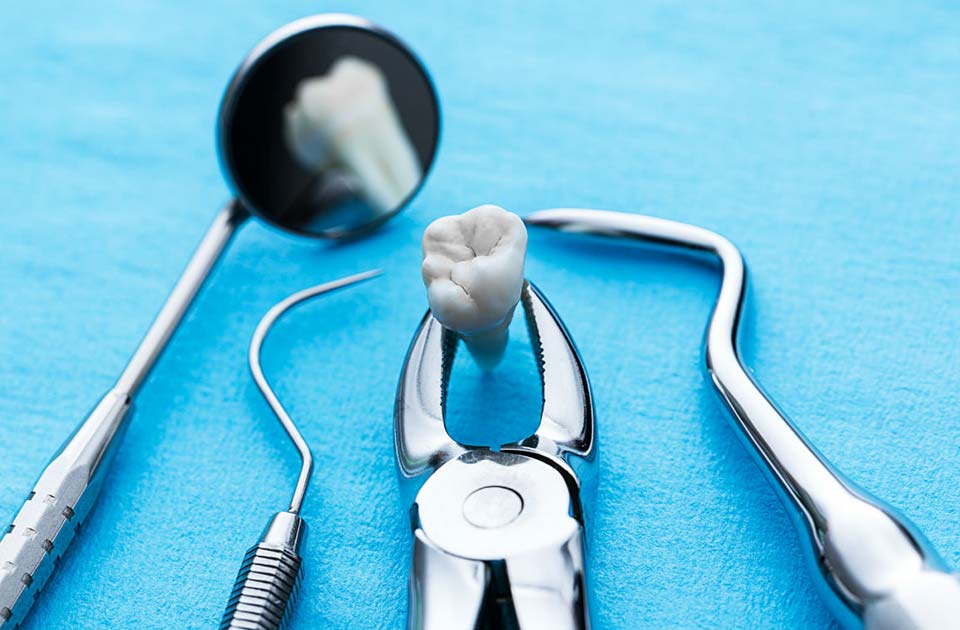 کشیدن دندان 