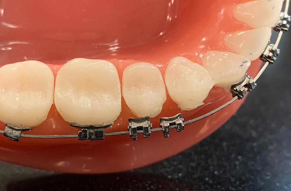 کنده شدن براکت ارتودنسی 