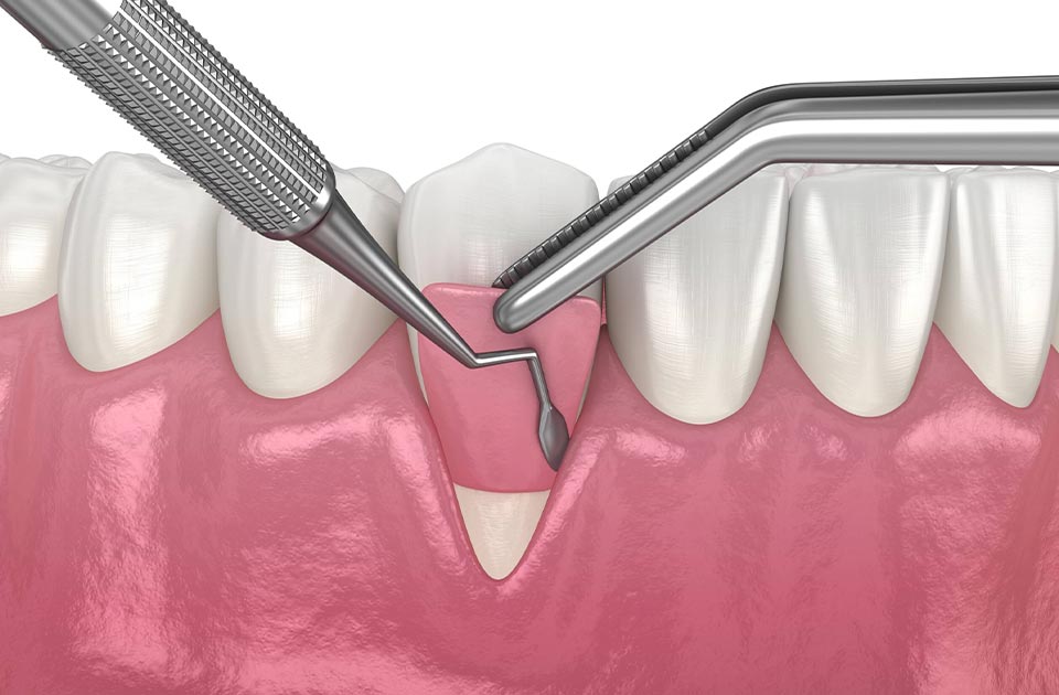 مراقبت های بعد از جراحی لثه