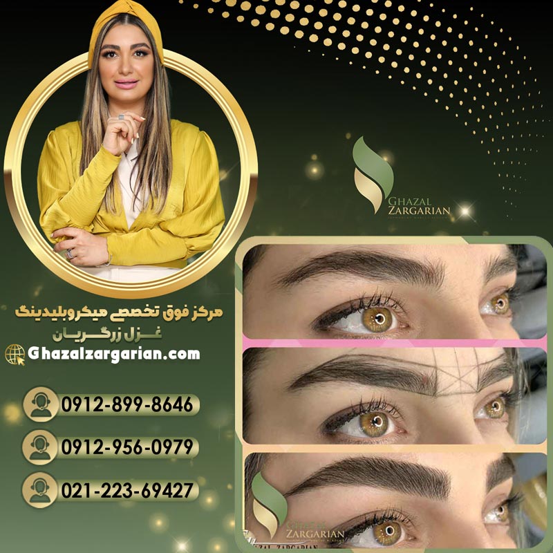میکروبلیدینگ غزل زرگریان به صورت کاملا نچرال