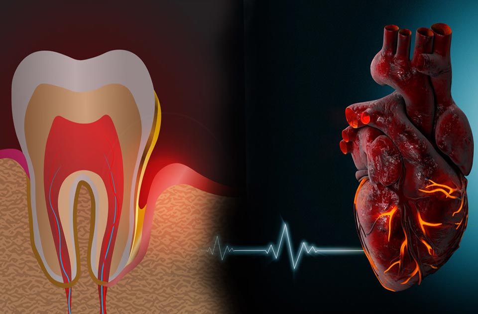 سکته قلبی و دندانپزشکی 