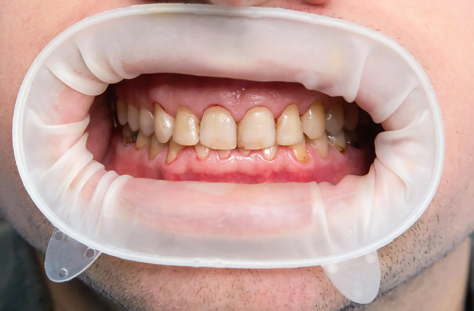 لکه قهوه ای رنگ لمینت دندان و درمان آن