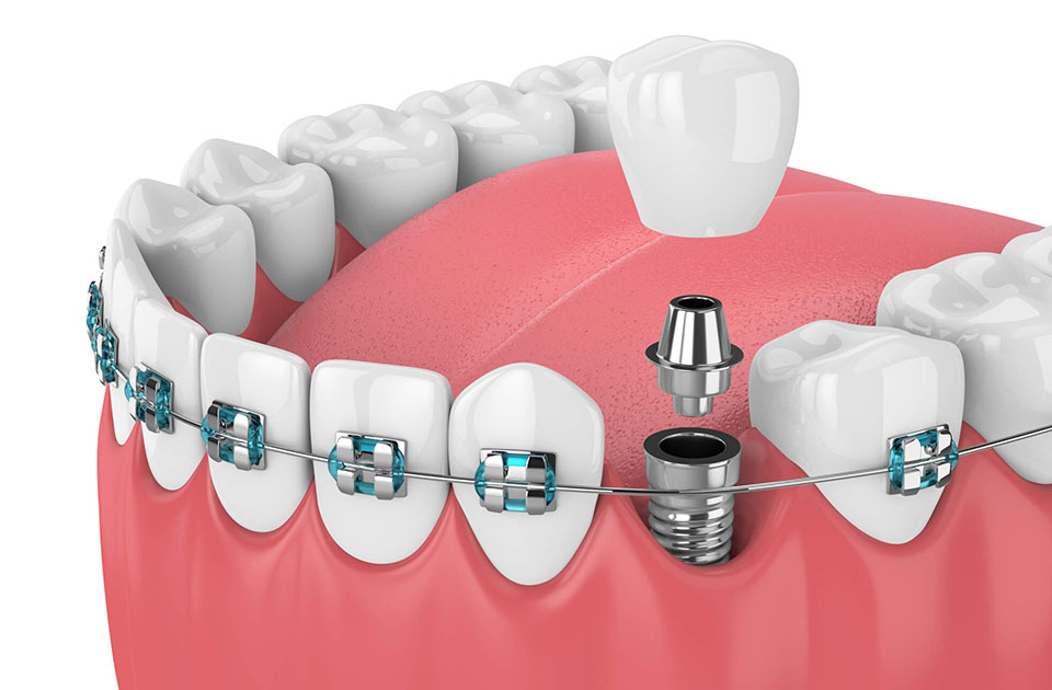 کاربرد ارتودنسی دندان 