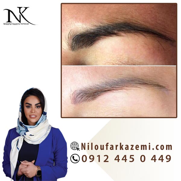 آموزش ریموو تاتو با بروزترین تکنیک در مرکزی تخصصی