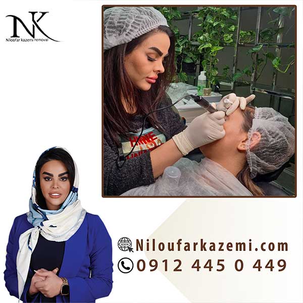 آموزش ریموو تاتو با جدیدترین تکنیک