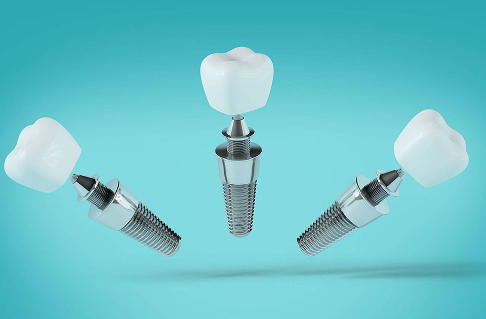 مراقبت و نگهدار یاز ایمپلنت مگاژن