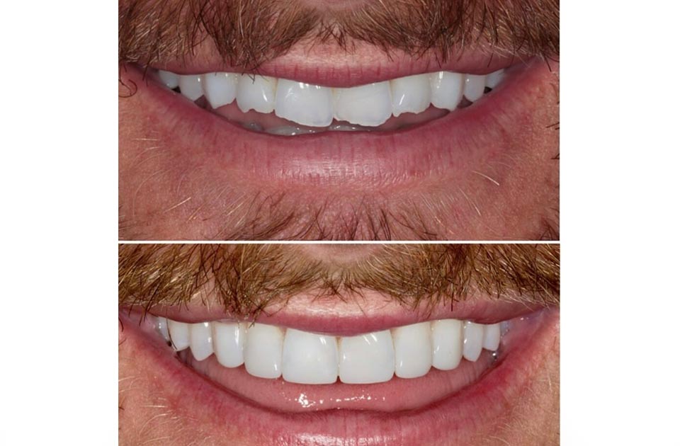 درمان تغییر رنگ کامپوزیت دندان ها 