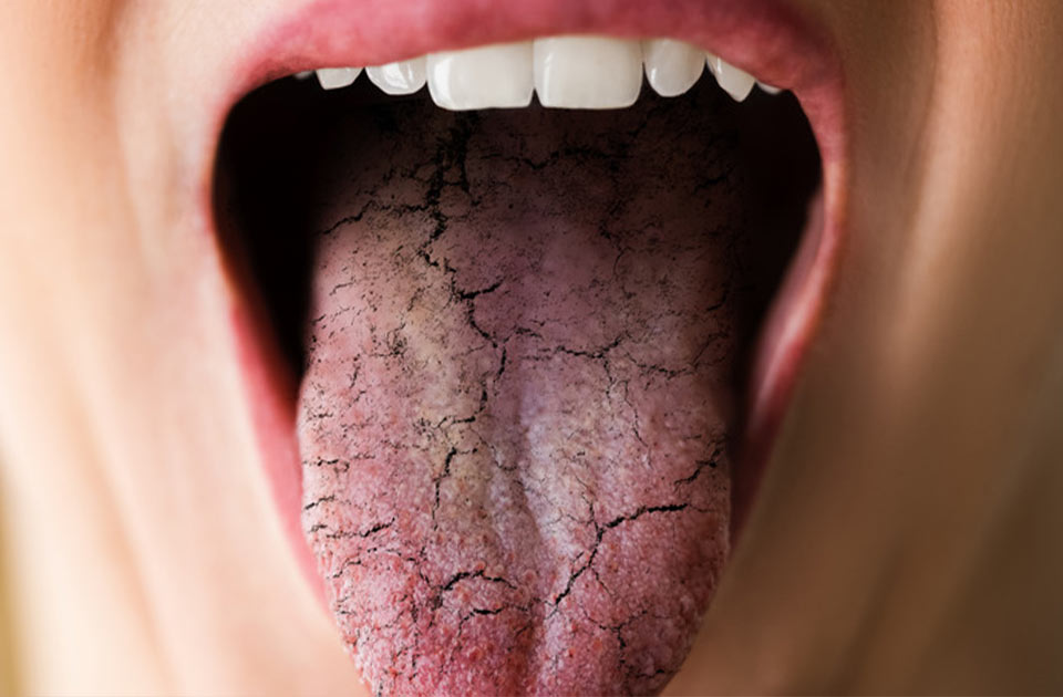 علل خشکی دهان 