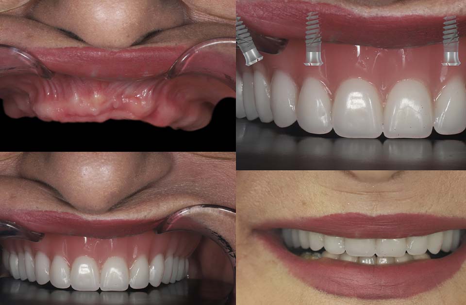 مراقبت های بعد از ایمپلنت دندان 