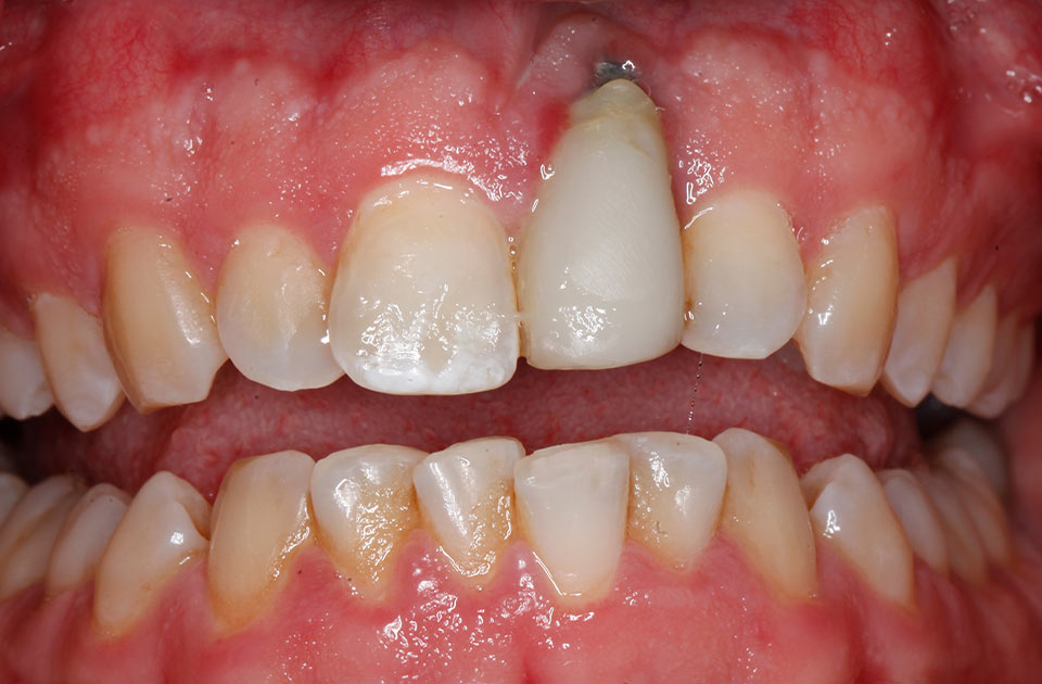 عفونت ایمپلنت دندان و عوارض ایمپلنت دندان