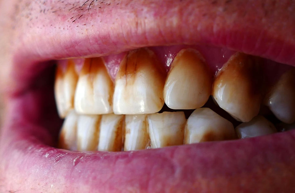 لکه قهوه ای رنگ لمینت دندان