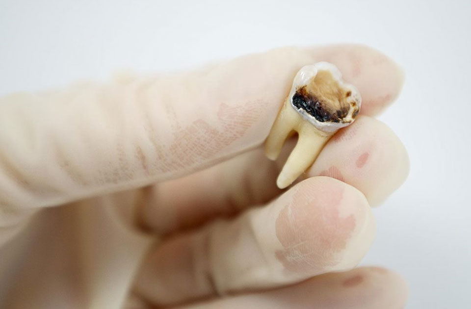 عفونت دندان