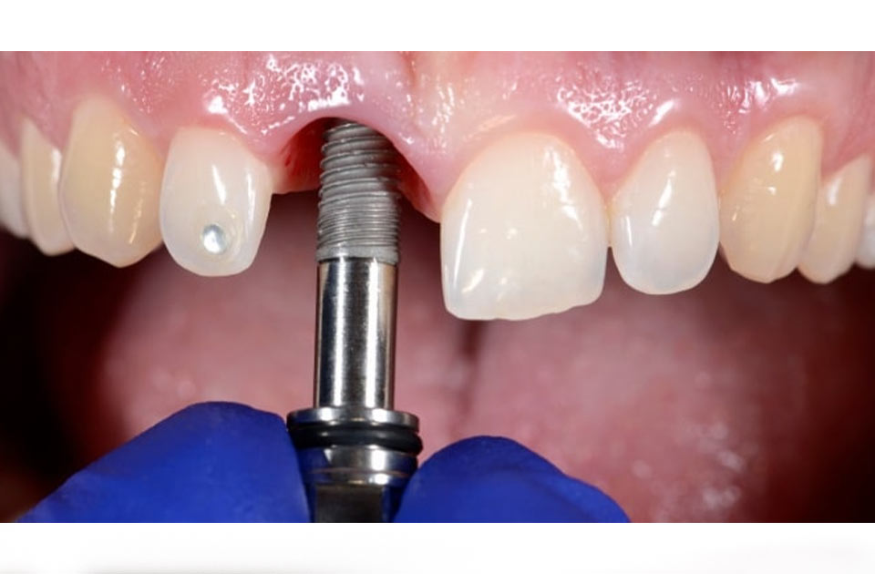 شل شدن ایمپلنت دندان
