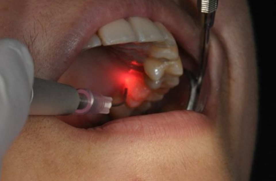 لیزر در دندانپزشکی 