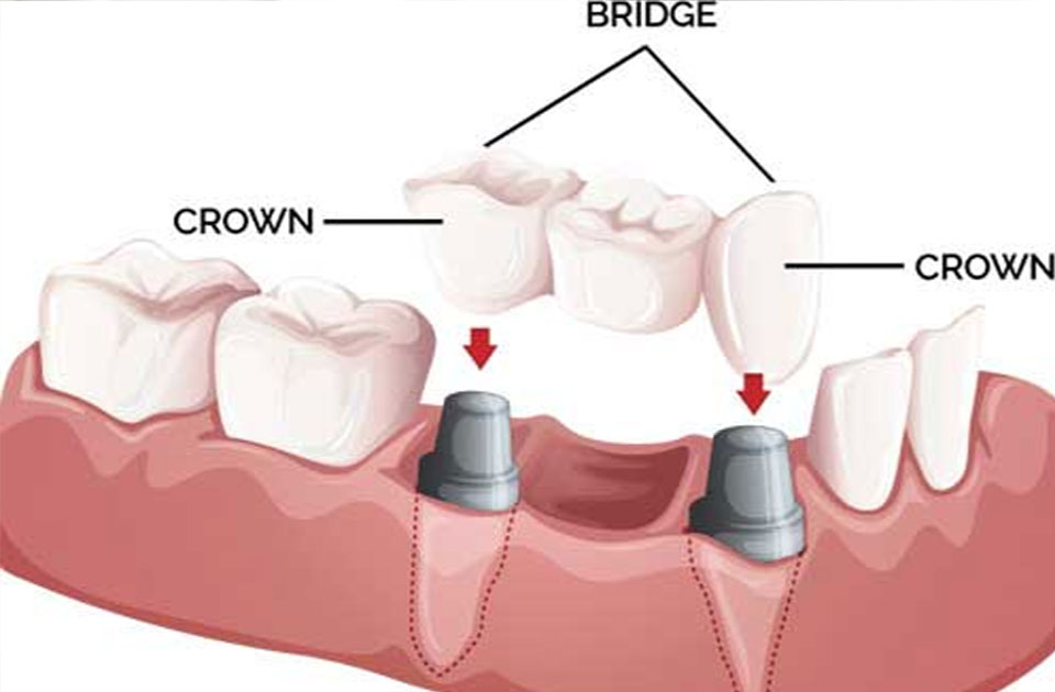 بریج دندان و مراقبت بعد از آن