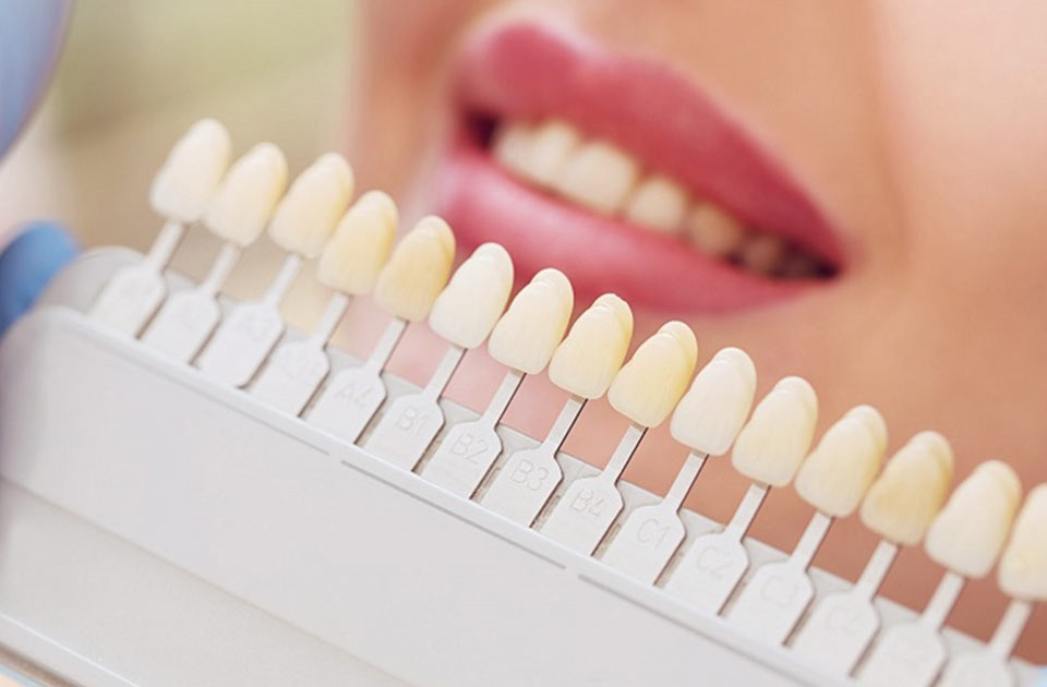 مزایای کامپوزیت آی پی اس 