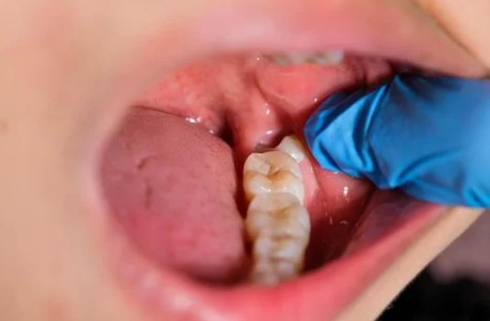 دندان کشیده شده و درد آن 