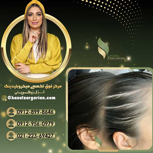 هاشور اسکالپ سر با رعایت پروتکل های بهداشتی