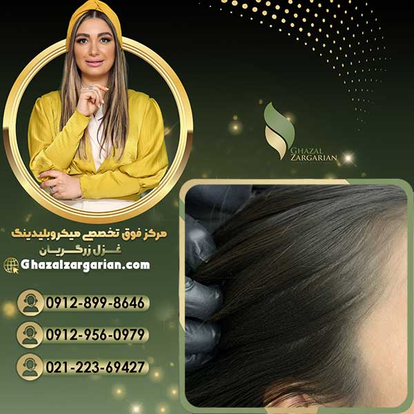 هاشور اسکالپ سر برای ازبین بردن طاسی