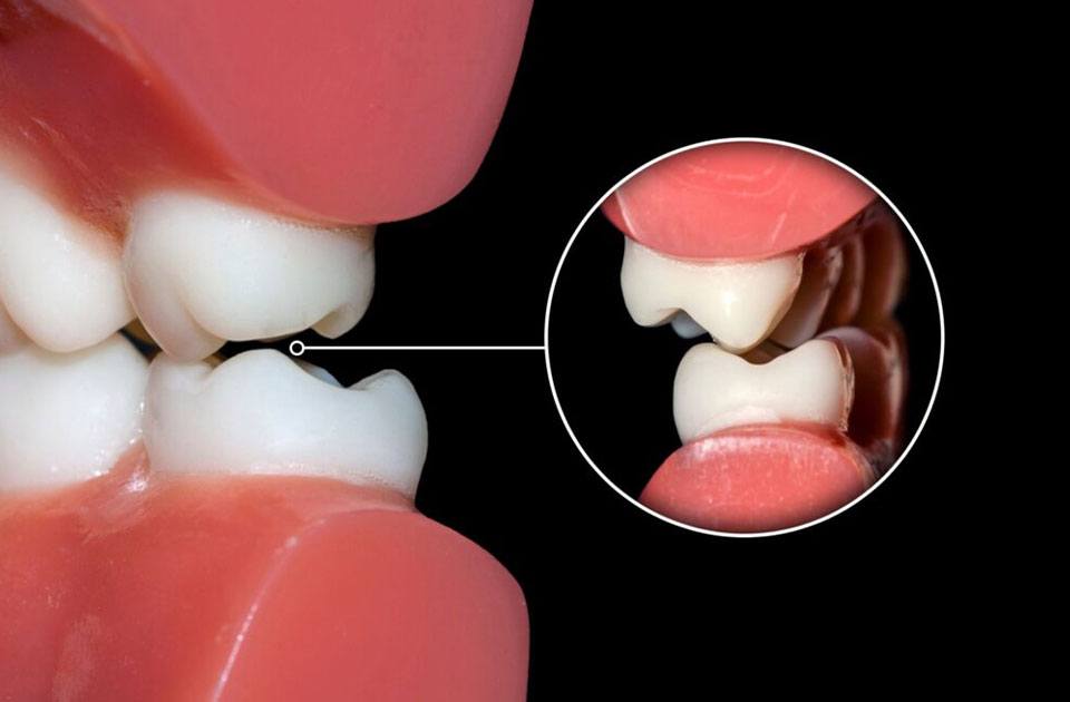 دندان قروچه یا براکسیسم