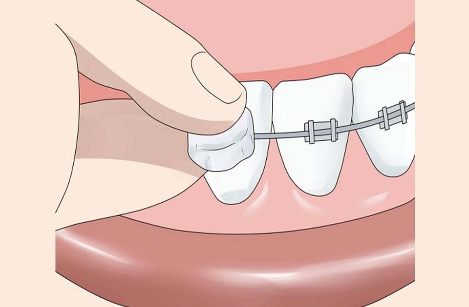 موم ارتودنسی چیست 