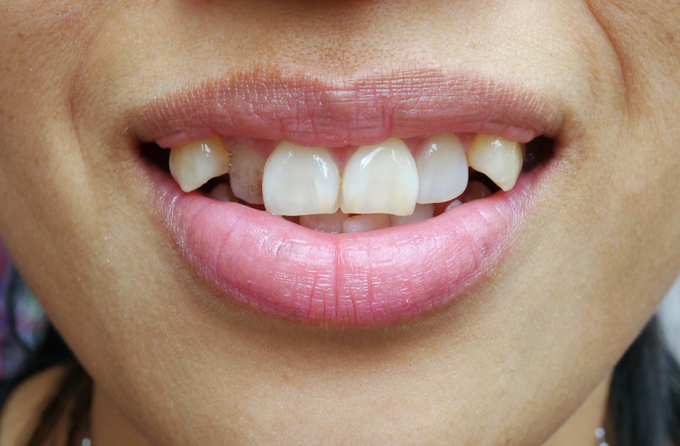 مشکلات مرتبط با دندان نیش