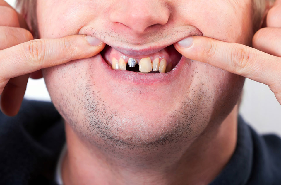 عوارض ایمپلنت دندان و عفونت