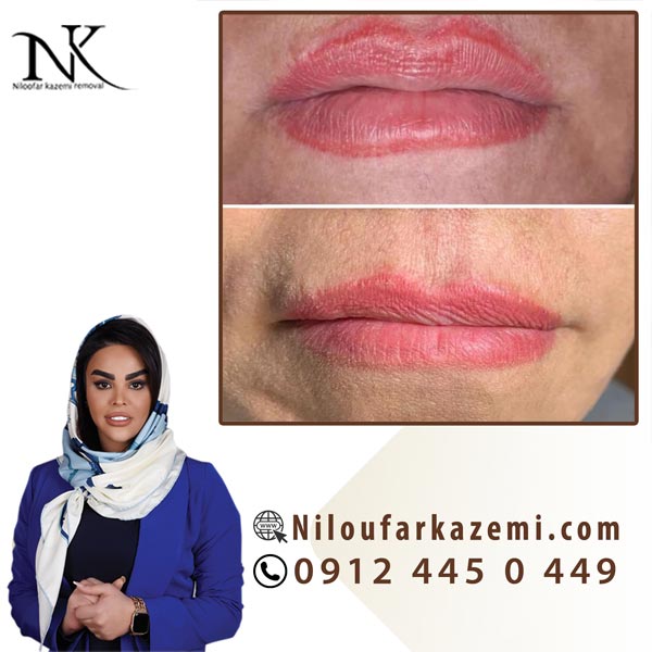ریموو تاتو خط لب بدون درد و عوارض